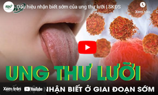 Dấu hiệu nhận biết sớm của ung thư lưỡi