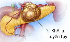 Ung thư tụy: Nguyên nhân, triệu chứng, cách điều trị và phòng bệnh