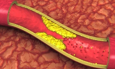 Vì sao kiêng ăn dầu mỡ, các chất béo mà mỡ máu vẫn cao?