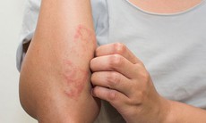 Thuốc trị bệnh Nocardia