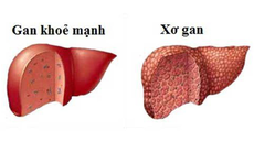 Biểu hiện nhận biết các giai đoạn của bệnh xơ gan