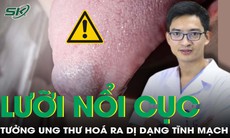 Lưỡi nổi u cục tưởng ung thư, đi khám phát hiện dị dạng tĩnh mạch