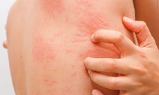 Câu hỏi thường gặp liên quan đến ấu trùng sán lợn