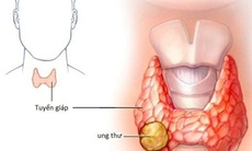 Các dấu hiệu điển hình của ung thư tuyến giáp ai cũng cần biết