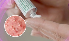 Các thuốc điều trị viêm nang lông