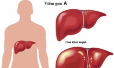 Viêm gan A là gì, nguyên nhân, triệu chứng và cách chữa trị