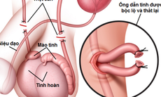 Thắt ống dẫn tinh có gây vô sinh và yếu sinh lý?