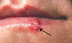 Phân biệt Herpes và nhiệt miệng