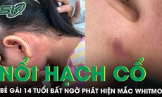 Phát hiện nữ sinh mắc Whitmore nổi hạch ở vùng cổ