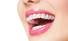 Các phương pháp điều trị lệch khớp cắn
