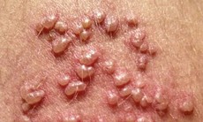 Câu hỏi liên quan bệnh Herpes sinh dục