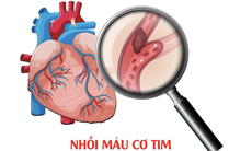 Lưu ý cho người từng bị nhồi máu cơ tim để tránh tái phát bệnh