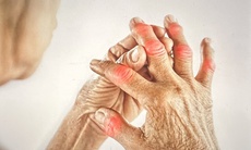 Chế độ ăn cho người bệnh Still - viêm khớp hiếm gặp