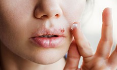 Những điều cần biết về mụn rộp Herpes