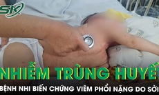 Bệnh nhi nguy kịch do mắc sởi biến chứng viêm phổi nặng, nhiễm trùng huyết