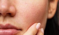 Bít tắc lỗ chân lông gây mụn, cần làm gì để khắc phục?
