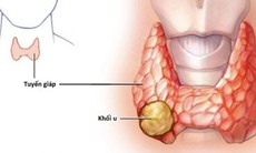 U tuyến giáp Tirads 3 có nguy hiểm không và cách điều trị thế nào?