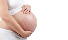 Làm gì để làm mờ các vết rạn da sau sinh?