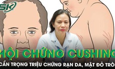 Rạn da, mặt đỏ tròn cẩn trọng với hội chứng Cushing 