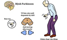 Uống cà phê có tốt cho người mắc bệnh Parkinson không?