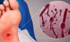 Ai cần tiêm uốn ván chủ động?