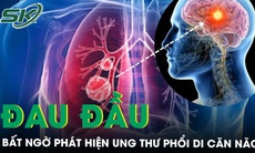 Bàng hoàng phát hiện ung thư phổi di căn não từ dấu hiệu thường xuyên đau đầu