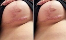 Quy trình cắt sẹo lồi tại phòng khám Edopi