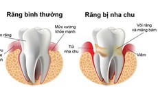 Không chủ quan với tình trạng viêm nha chu