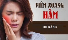 Khi nào cần nghĩ đến viêm xoang hàm do răng?