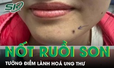 Bất ngờ phát hiện ung thư da từ một nốt ruồi son