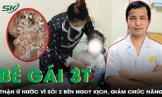 Tán sỏi qua da cứu bé gái 33 tháng tuổi bị sỏi thận hai bên nguy kịch