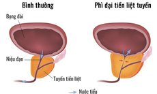 Biến chứng suy thận khi mắc phì đại tuyến tiền liệt