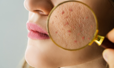6 dấu hiệu trên da cảnh báo gan cần được chăm sóc ngay