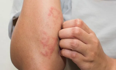 5 nhóm thực phẩm nên ăn để giảm ngứa da