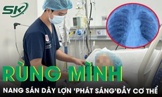 Rùng mình nang sán dây lợn ‘phát sáng’ vôi hóa đầy cơ thể 