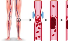 7 dấu hiệu cảnh báo sớm cục máu đông, phòng ngừa như thế nào?