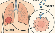 Cách phát hiện sớm ung thư phổi