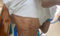 Công an triệu tập cha dượng nghi bạo hành bé gái