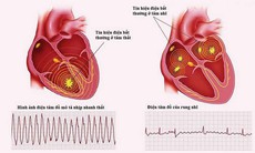 Tại sao rung nhĩ lại nguy hiểm?