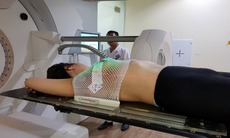 Mặt trái của xạ trị và hóa trị: Hiểm họa ung thư thứ phát