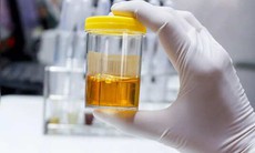 5 dấu hiệu cảnh báo axit uric cao và sỏi thận, phòng ngừa như thế nào?