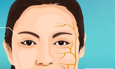 Phòng ngừa liệt dây thần kinh số VII