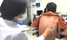 Tự chữa vảy nến, bệnh nhân không đi lại được, phải nằm cáng nhập viện