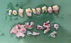 Hy hữu: Bác sĩ phẫu thuật 'nhổ' 10 cái răng trong bụng bệnh nhân có khối u quái buồng trứng