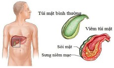 Dấu hiệu của viêm túi mật theo từng giai đoạn