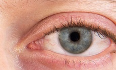 Khô mắt do rối loạn hệ miễn dịch