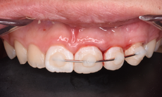 Xử trí chấn thương răng cửa như thế nào?