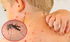 Đã có hơn 86.000 ca mắc sốt xuất huyết, bệnh ngày càng khó lường hơn do biến đổi khí hậu