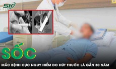 Hút thuốc lá gần 3 thập kỷ, người đàn ông sốc khi phát hiện mắc bệnh cực nguy hiểm