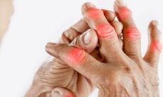 Bị viêm khớp nên ăn gì, kiêng gì?